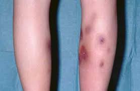 Image result for erythema nodosum