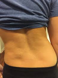 Muscles of the back can be divided into superficial, intermediate, and deep group. Lumbar Disc Herniation With Radiculopathy A Case Study Rayner Smale