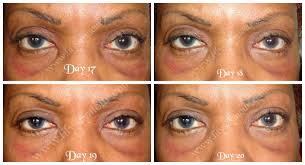 Pin On Blepharoplasty Eyelid Surgery