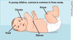 Giving baby a bath without harming that delicate skin is one more minefield for new parents to what if my baby has a skin condition? Eczema Atopic Dermatitis For Parents Nemours Kidshealth