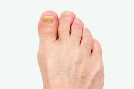 Image result for Onychogryphosis feet