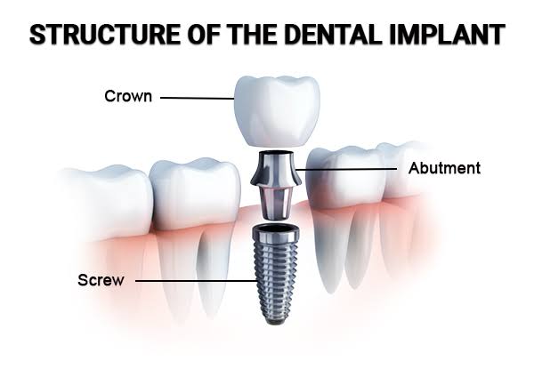 Dental Implant product image