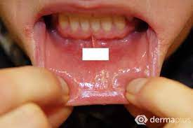 Die lippen schwellen normalerweise aufgrund von traumata oder allergien an. Normal Dass Lippe Innen Uneben Ist Mundschleimhaut