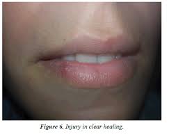Angiomas of lips and gi disorders. Vascular Lesion Of The Lip Treated With A Diode Laser A Case Report