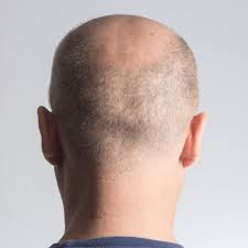 If i were you, i would tell her how you feel. 4 Ways To Know If You Are Going Bald Hair Loss In Men Skalp