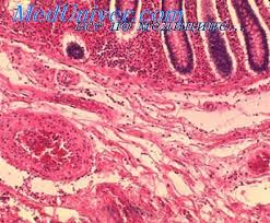 Кожа и мягкие тканиstaphylococcus aureus, streptococcus spp., enterobacteriaceae. Morfologiya Bolezni Legionerov U Detej Sepsis U Rebenka