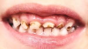Pediatric Dentistry For Children Ages 6 10 Children S Dental Care