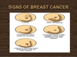This disease originates in the nipple. Breast Cancer