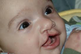 The outcome of cleft lip and/or cleft palate repair will improve your child's quality of life, including the ability to breathe, eat and speak. October Cleft Uk Study News And Features University Of Bristol