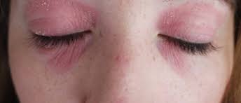 Eczema on the eyelid is likely to develop due to combination of sensitive, dry skin and malfunction in the immune mechanism. How I Got Rid Of My Eye Eczema Lux Life London