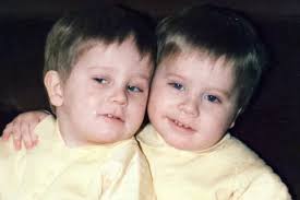 Agony of identical twins born with rare genetic disease that has left one  of them with huge tumours