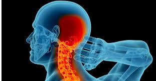 Occipital Headaches Veterans Disability Lawyer Friedman Disability