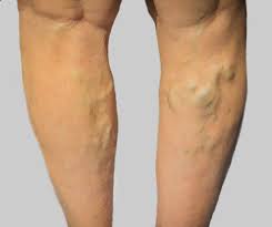 They usually occur in the legs, but also can form in other parts of the body. Varicose Veins Vein Clinic At Novus Spine Pain Center Lakeland Fl