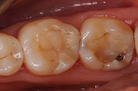 Allow for easy identification of tooth decay nearby. The Ideal Composite Build Up In Posterior Indirect Restorations