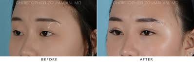 In the frontal area, the . Asian Eyelid Double Eyelid Surgery Before And After Photo Gallery