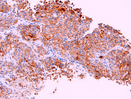 Implications for diagnosis and histogenesis. Pathology Outlines Mesothelioma Versus Adenocarcinoma