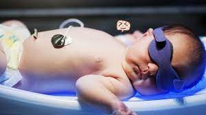 Bilirubin meracuni mata yang bisa berakibat kebutaan, pada telinga berakibat. Bayi Kuning Saat Baru Lahir Ketahui Tanda Dan Cara Mengatasinya Orami