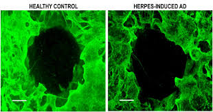Herpes is separated into two types: Bioengineered Brain Model Shows Hsv 1 May Be Responsible For Some Cases Of Alzheimer S