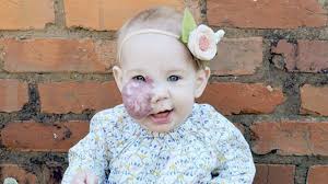 Mom Breaks Down Stigma Around Daughter's Birthmark With Gorgeous Photos