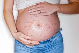 Image result for pruritic urticarial papules and plaques of pregnancy