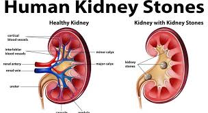 Human Anatomy Diagram With Kidney Stones Illustration Kidney Stones Human Kidney Renal Calculi