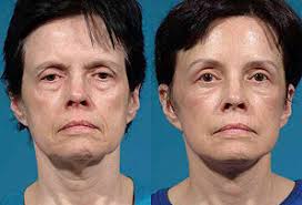 Jay Burns, MD, Board Certified Plastic Surgeon