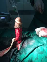 درمان کجی آلت تناسلی مردان