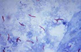 Nastaje kao posljedica hematogene propagacije uzročnika iz nekog žarišta unutrašnjih organa. Tuberkulose Biologie