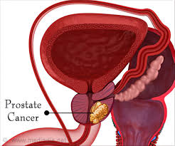 The better health channel was established by the victorian (australia) state government. Finasteride Is Safe And Effective Preventive Strategy For Prostate Cancer