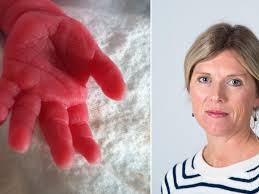 To av tre ekstrempremature får helseplager