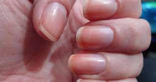 بالصور 4 تغيرات فى لون الأظافر تدل على مشاكل صحية أبرزها الكبد والقلب اليوم السابع