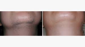 Other potential side effects are swelling, redness, and scarring. Laser Hair Removal On The Face Cost Procedure And More