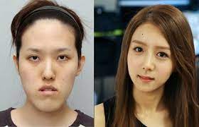 ボード korean plastic surgery のピン