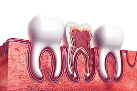 Maybe you would like to learn more about one of these? Get Relief From An Infected Tooth With A Root Canal Treatment