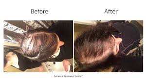By naturally blocking dht, you maintain your testosterone levels and your hair follicles are never exposed to the harmful effects of dht, which can prevent new hair loss. Drformulas Dht Blocker Hairomega Dht Natural Pills For Hair Loss