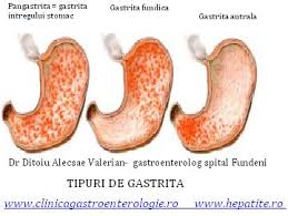 Ce trebuie sa stii despre durerile in sarcina. Nervi La Stomac 0758751841 Cabinet De Gastroenterologie Si Hepatologie Bucuresti