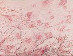 However, children usually get them on their: Stds Molluscum Contagiosum Free Medical Atlas