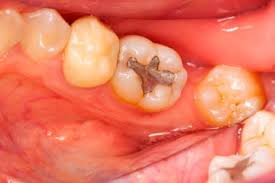 A novel vaccine, like an mrna vaccine, doesn't have a manufacturer that can produce at a that means it could take more time before a vaccine based on that technology is widely available. Cavity Filling Howstuffworks