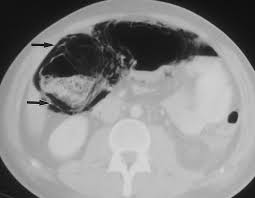 Image result for Neutropenic Colitis