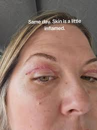 Upper Bleph Stitch Removal