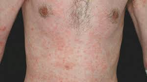 Skabies Altmeyers Enzyklopadie Fachbereich Dermatologie