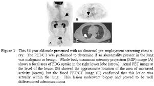 Scielo Brazil Common Causes Of False Positive F18 Fdg Pet Ct Scans In Oncology Common Causes Of False Positive F18 Fdg Pet Ct Scans In Oncology