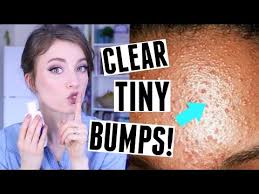 How I Got Rid Of Tiny Face Bumps Current Skin Care Routine Youtube Skin Bumps Pimples On Forehead Forehead Acne
