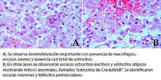 La esclerosis múltiple es una enfermedad crónica, con una clínica muy variable que evoluciona de manera diferente en cada caso. Diagnostico Temprano De La Esclerosis Concentrica De Balo Mediante Tractografia Por Tensor De Difusion Reporte De Caso Y Revision Medwave