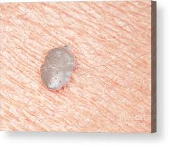 Image result for scabies on human skin