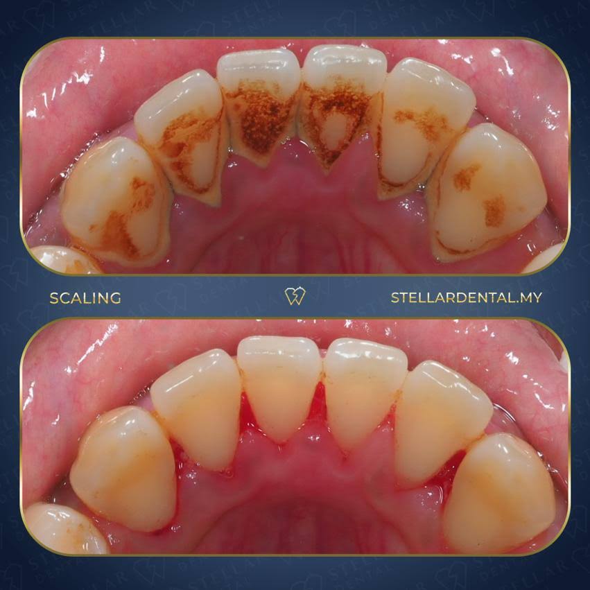 Scaling and polishing product image