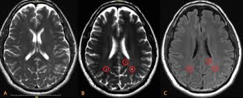 Brain scans such as mris and ekgs allow researchers and doctors to look for patterns. Progressive Focal Gray Matter Volume Loss In A Former High School Football Player A Possible Magnetic Resonance Imaging Volumetric Signature For Chronic Traumatic Encephalopathy The American Journal Of Geriatric Psychiatry