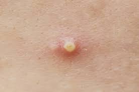 Was hilft bei trichodynie, juckender kopfhaut und schmerzen auf dem kopf? Pityriasis Versicolor Kleienpilzflechte Symptome Therapie