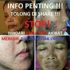 Produk kecantikan yang selamat dan berkesan 2021 / 2020. Akibat Penggunaan Produk Merkuri Dalam Kosmetik Shidarahmat
