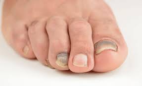 Brown Spots Under Toenail Causes Prevention Treatment Occasionally, dark discoloration of the nail bed is merely a matter of skin tone.
